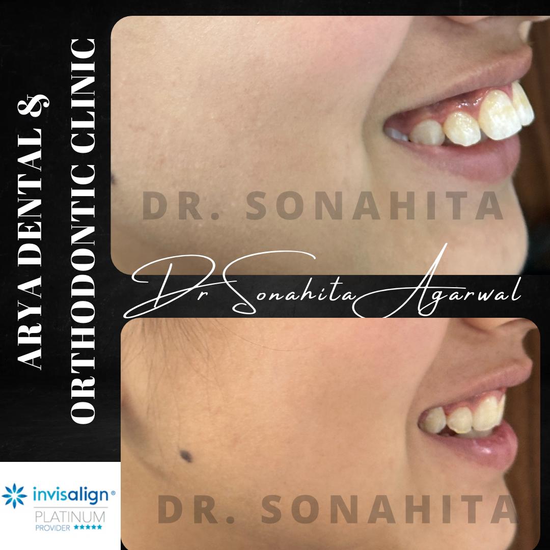 Patient smile transformation 4